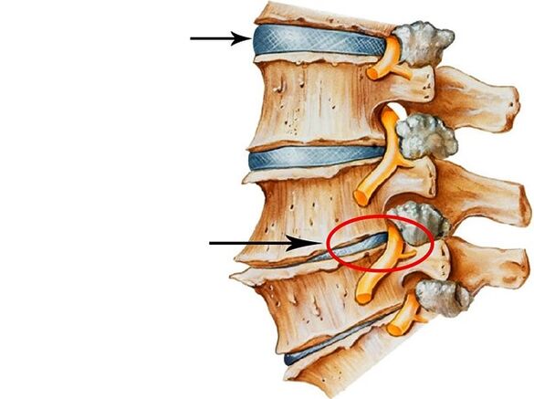 Enfermedades de discos intervertebrales