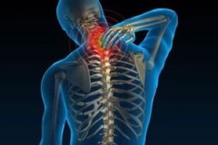 Dolor del cuello causado por el hueso cervical y la condropatía