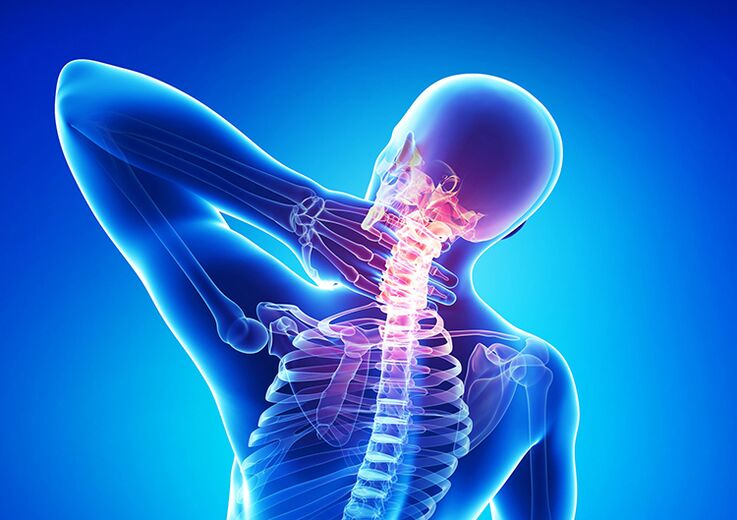 La osteocondrosis espinal es una enfermedad que afecta el cartílago de las articulaciones y las vértebras.