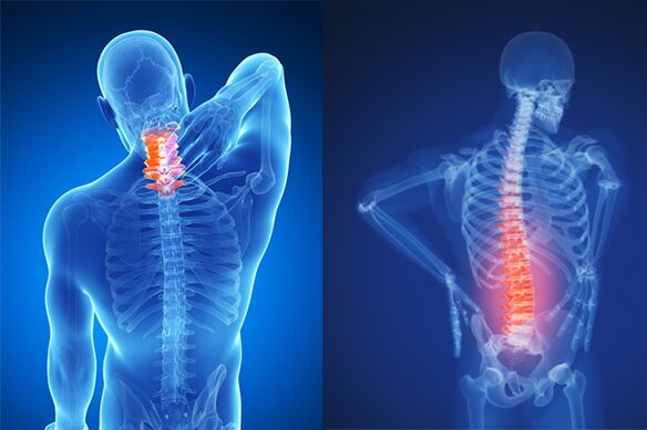 Osteocondrosis cervical y lumbar