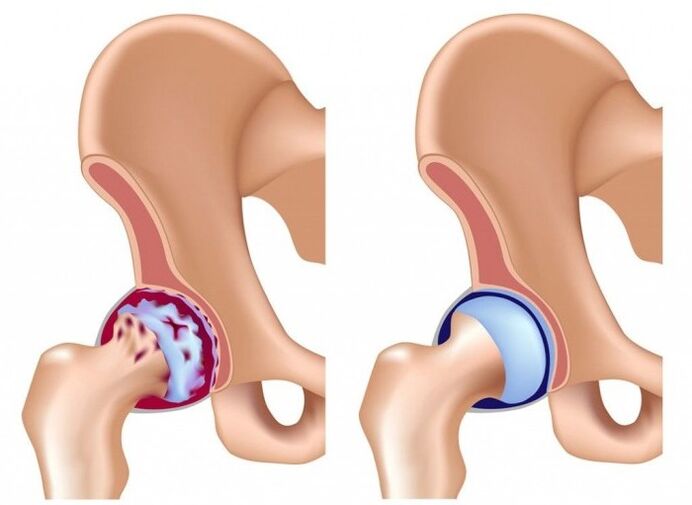 Lesiones de cadera causadas por articulaciones.