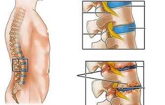 Causas de vértebras lumbares